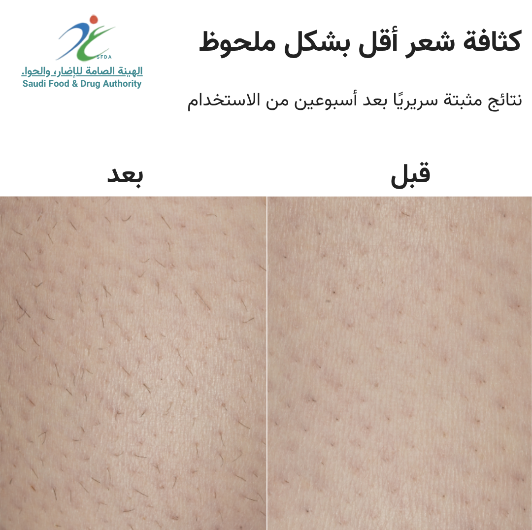 سموث سكين بيور سويتش IPL