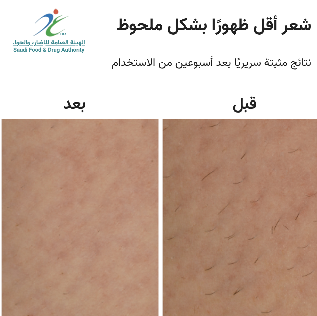 سموث سكين بيور سويتش IPL