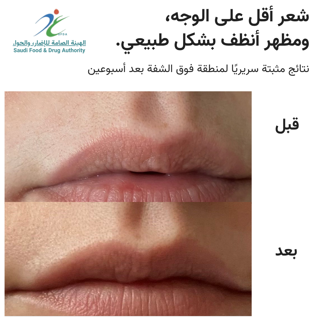 سموث سكين بيور سويتش IPL