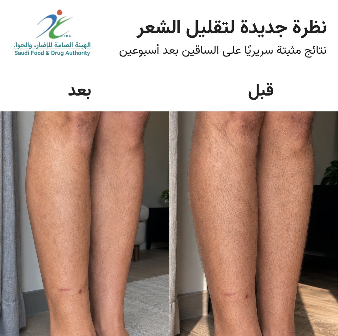 سموث سكين بيور سويتش IPL