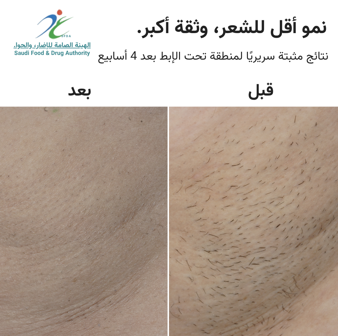 سموث سكين بيور سويتش IPL