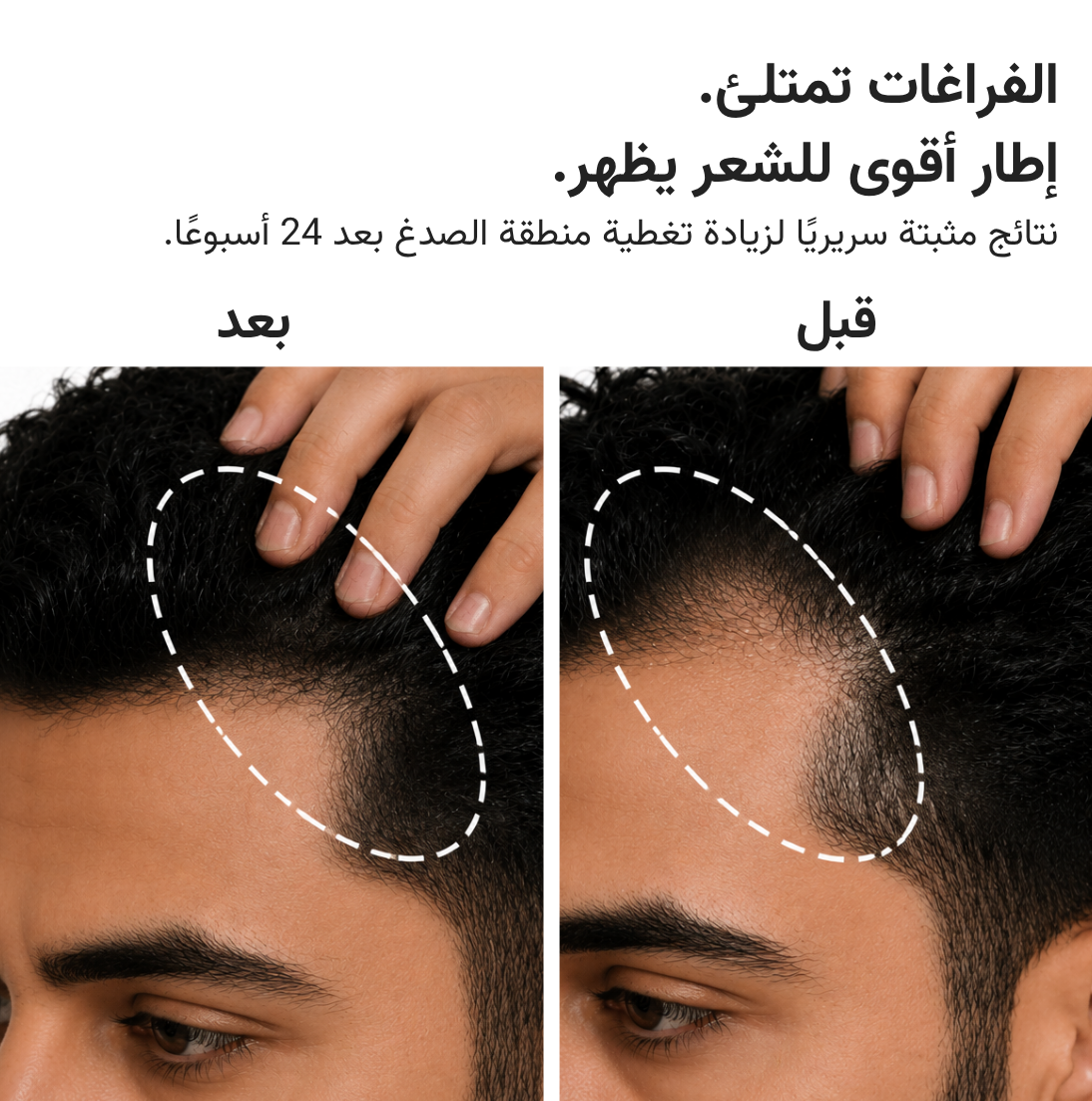 قبعة HairMax ليزر 272