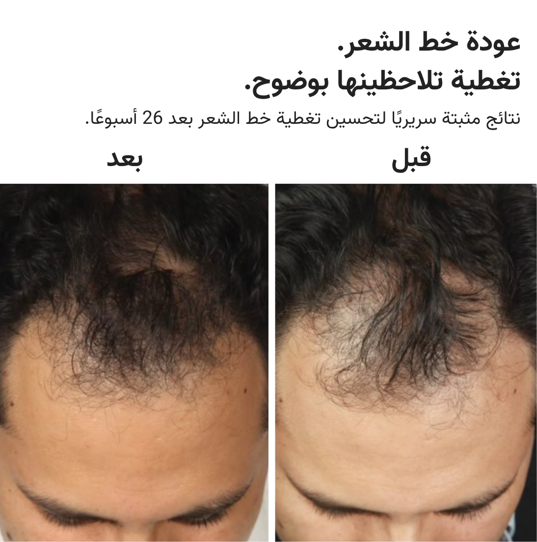 قبعة HairMax ليزر 272