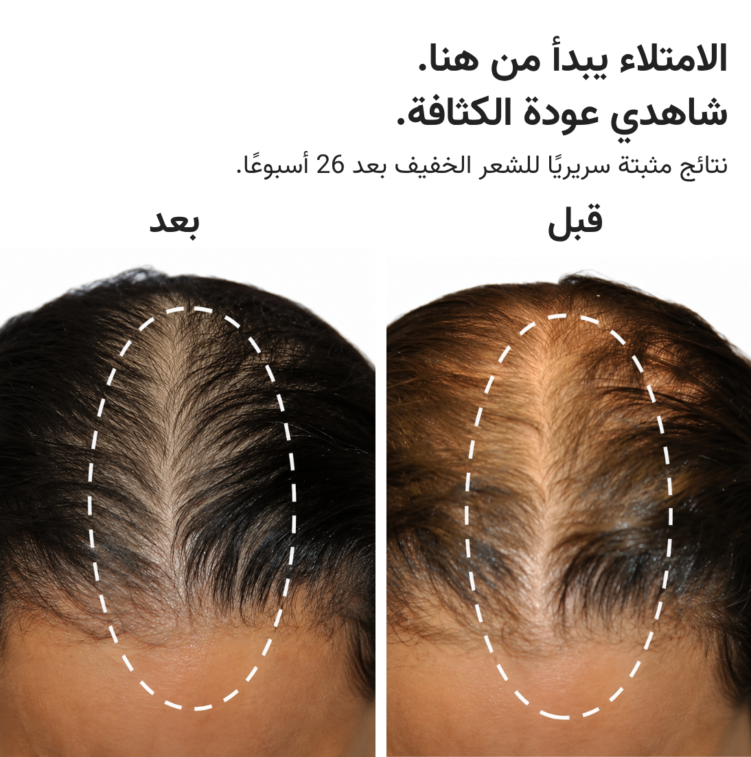 قبعة HairMax ليزر 272
