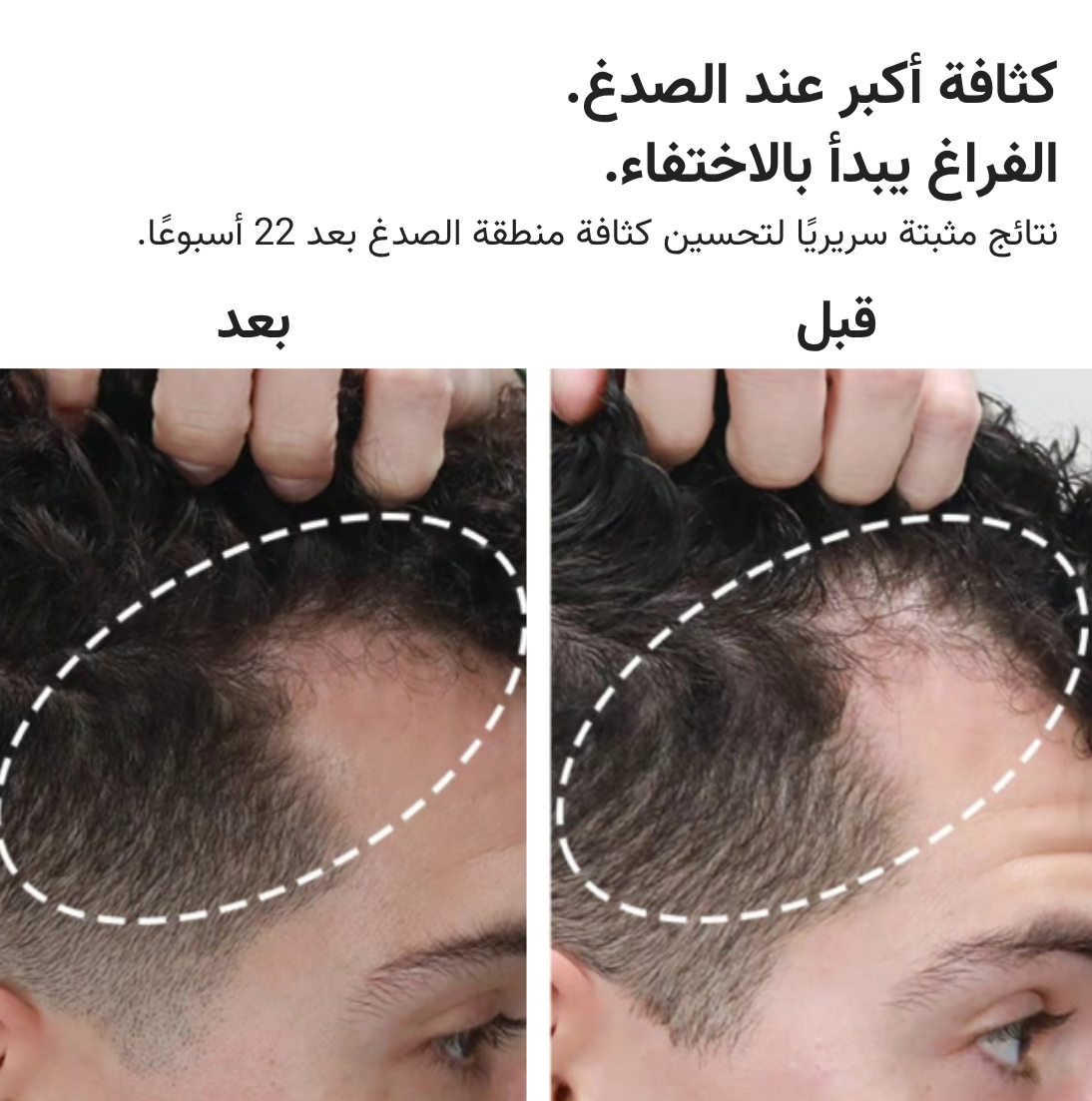 قبعة HairMax ليزر 272