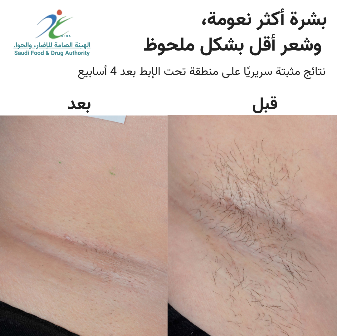 سموث سكين بيور سويتش IPL