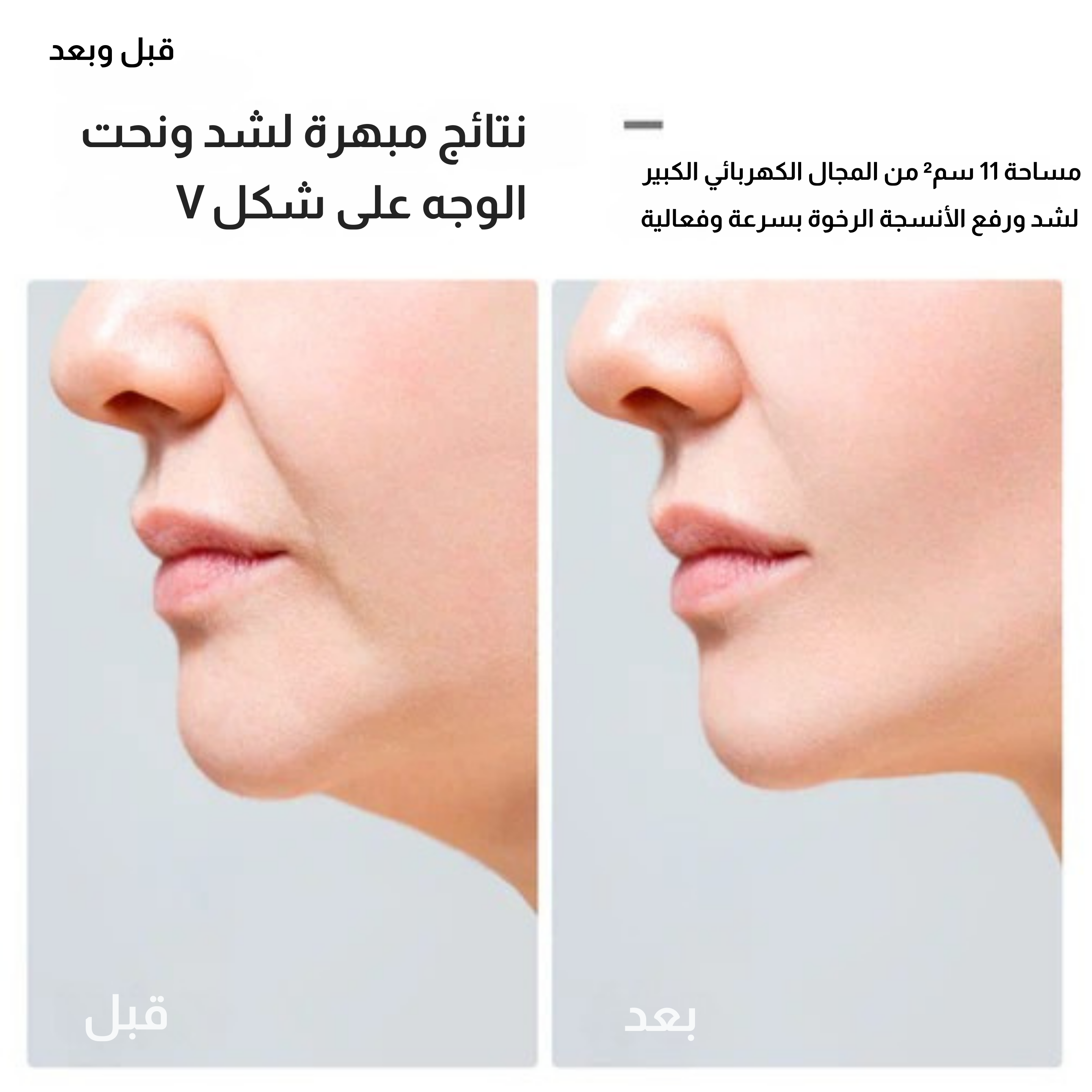 جهاز JOVS V-Lift للشد