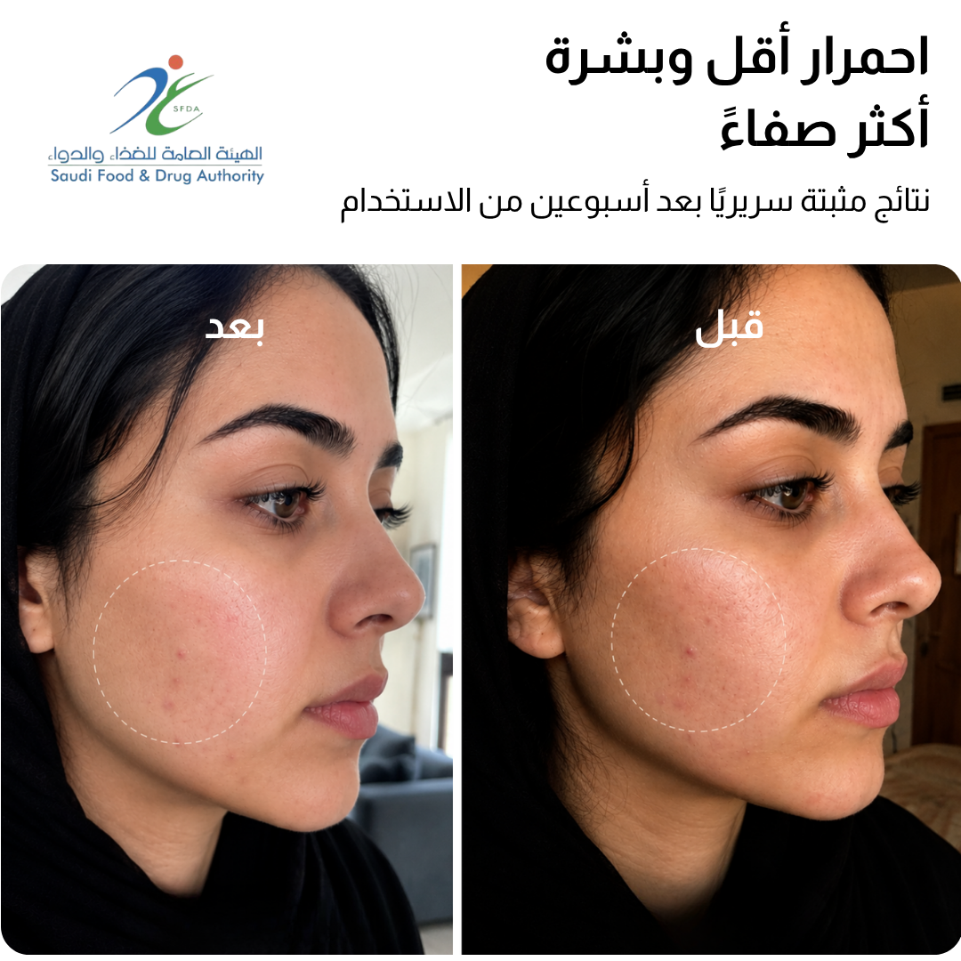 قناع JOVS 4D بالليزر