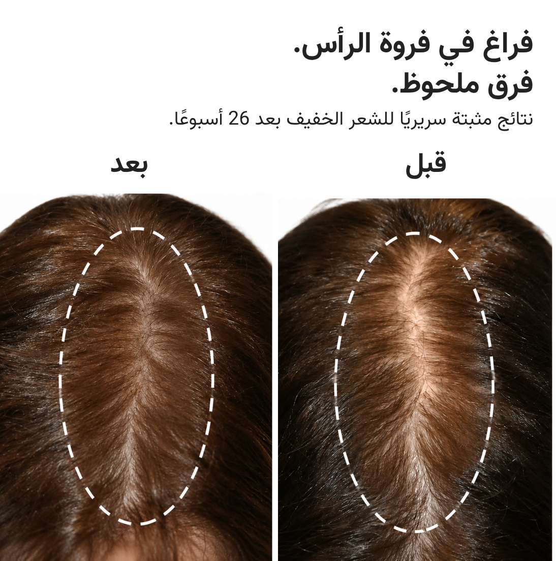 قبعة HairMax ليزر 272