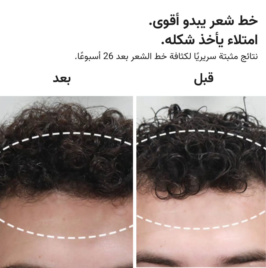 قبعة HairMax ليزر 272