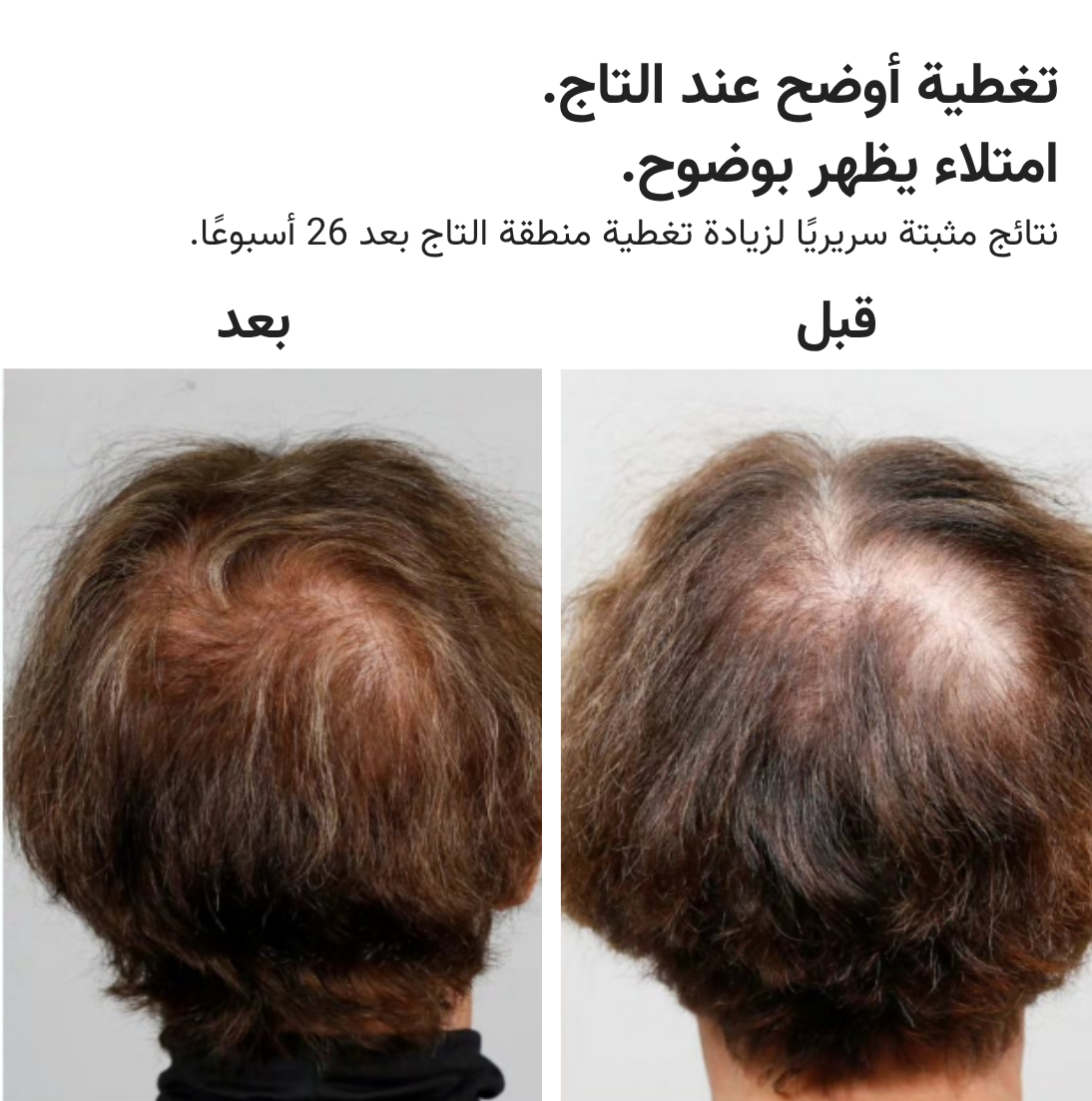 قبعة HairMax ليزر 272