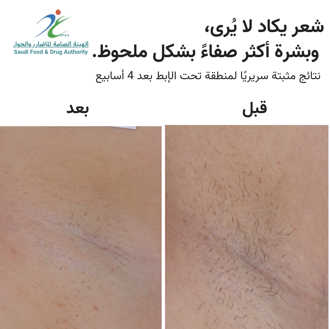 سموث سكين بيور سويتش IPL
