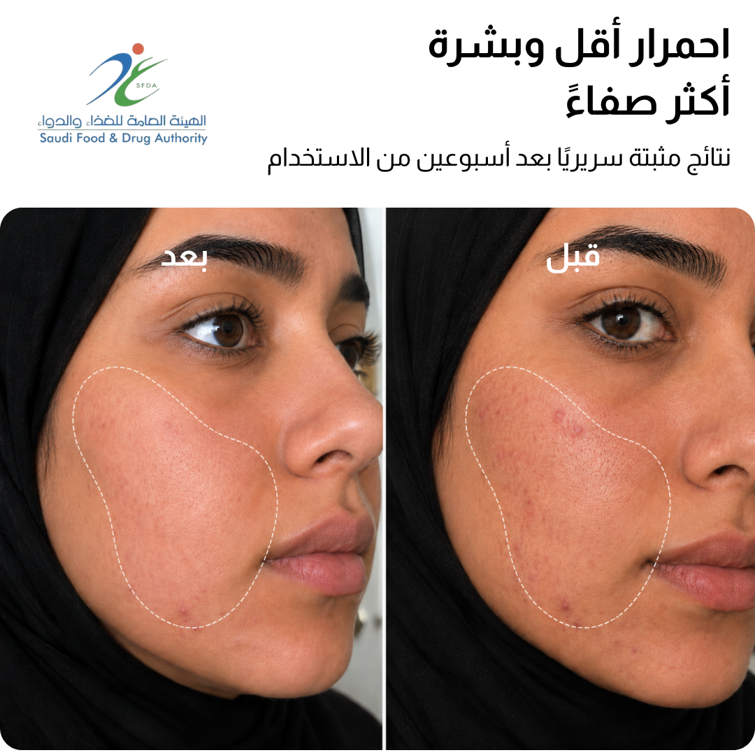 قناع JOVS 4D بالليزر