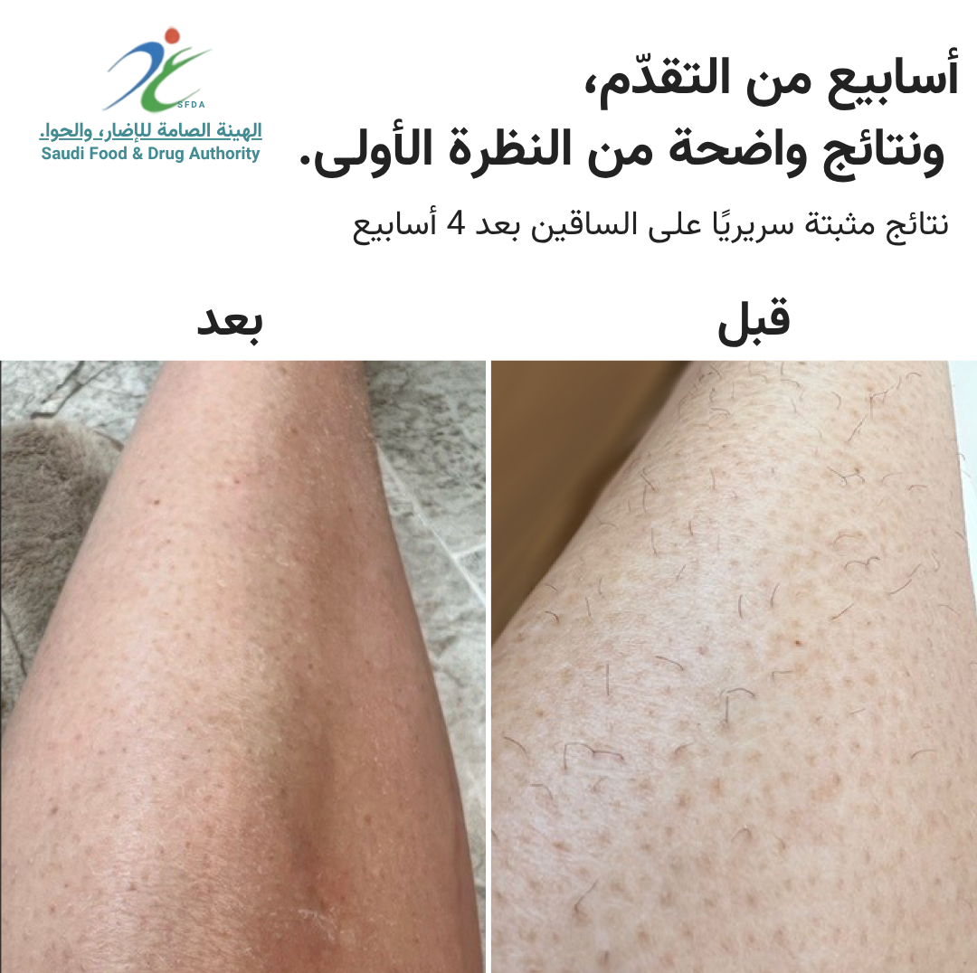 سموث سكين بيور سويتش IPL