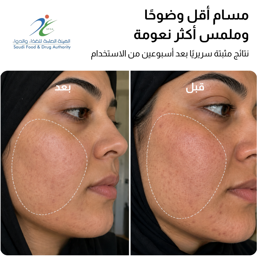 قناع JOVS 4D بالليزر