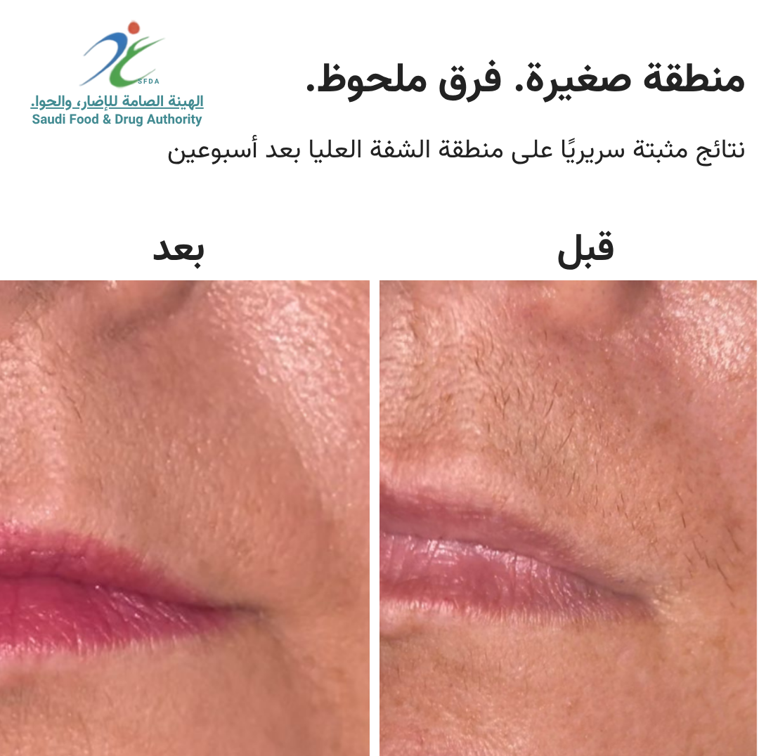 سموث سكين بيور سويتش IPL